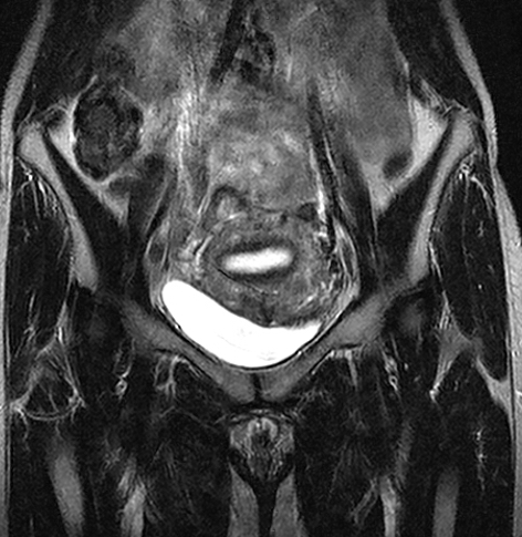 Pelvis Coronal MRI scan